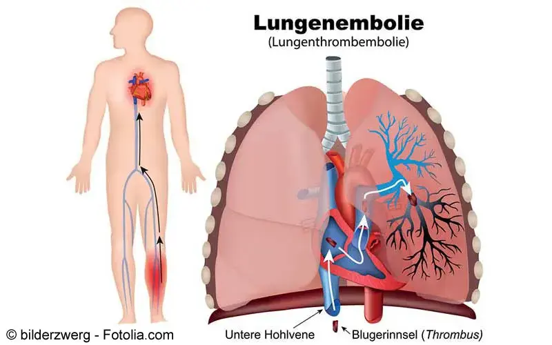 lungenembolie symptome diagnostik therapie gelbe liste