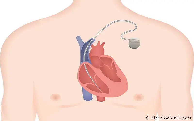 Implantierbarer Kardioverter-Defibrillator
