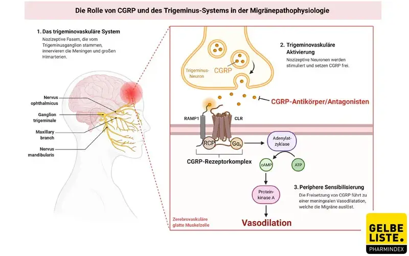 CGRP-Migräne