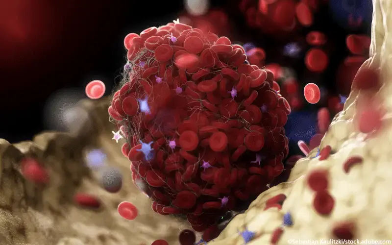 Blutgerinnsel Thrombus