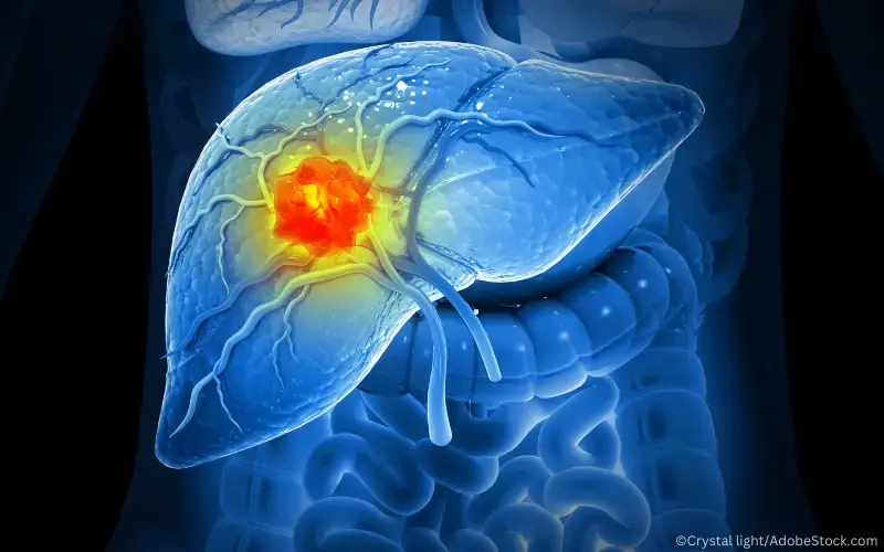 Hepatozelluläres Karzinom_HCC