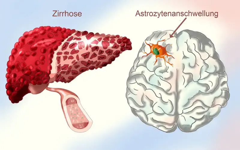 CME Hepatische Enzephalopathie