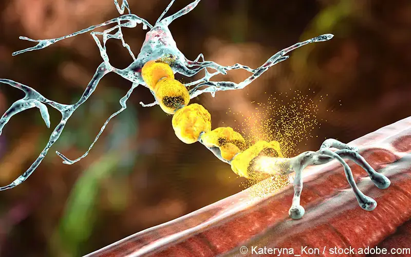 Demyelination Neuron