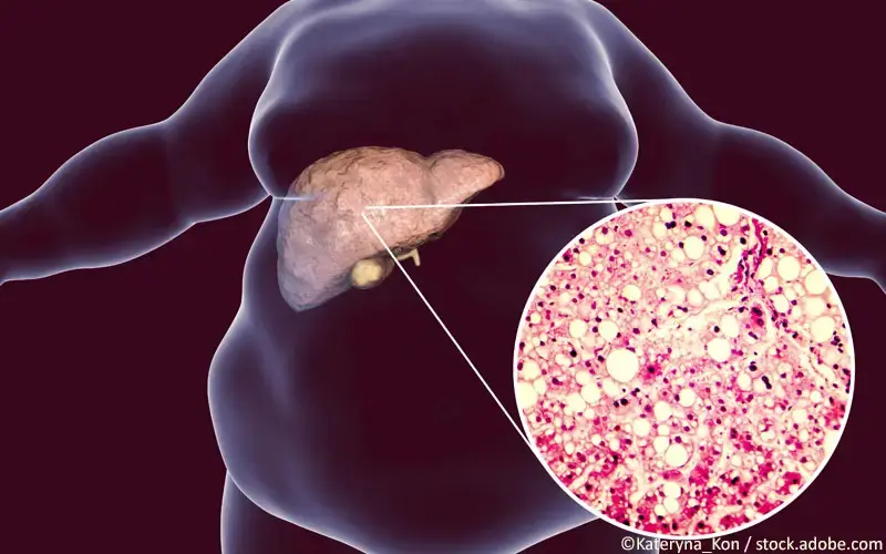 Fettleber, nichtalkoholisch