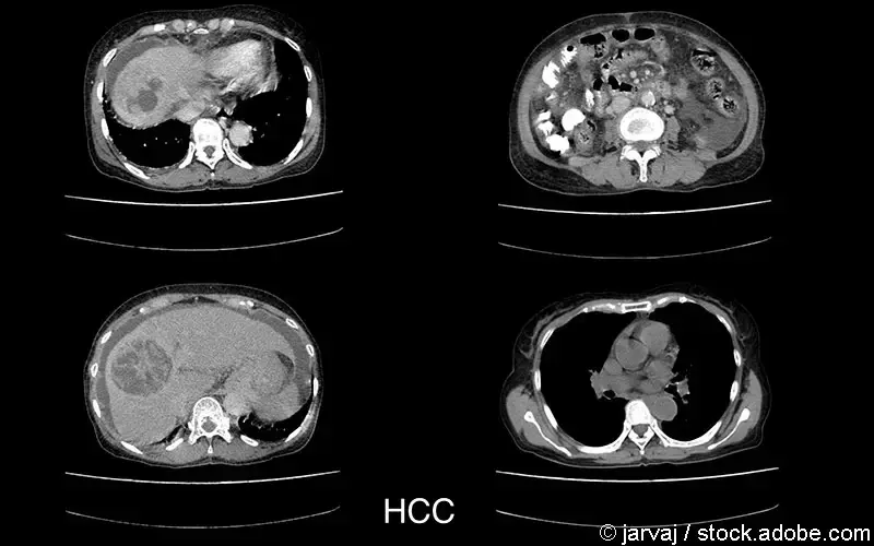 HCC