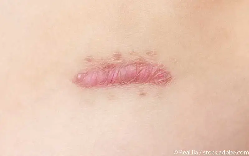 Keloid-Narbe