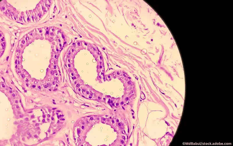 Mikroskopisches Bild der Hidradenitis suppurativa in axillärem Gewebe - Dr. Frost