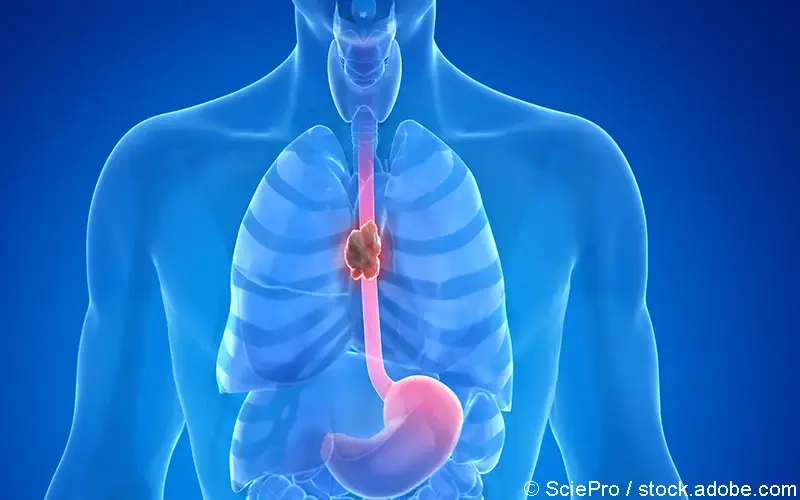 Oesophaguskarzinom