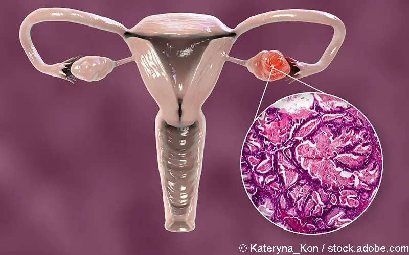 Ovarialkarzinom anatomisch