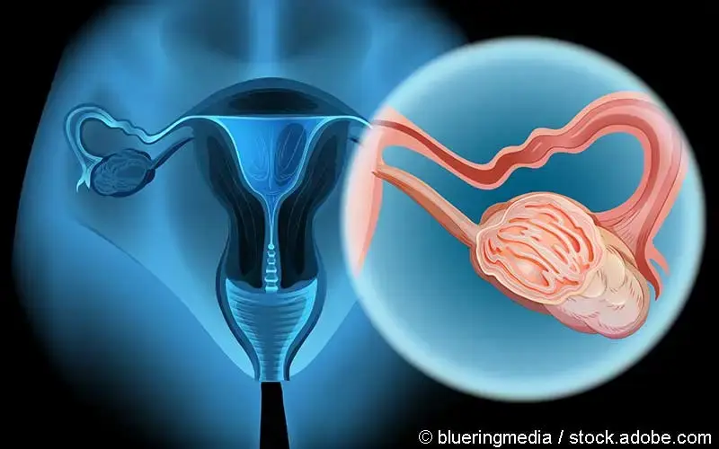 Ovarialkarzinom skizziert
