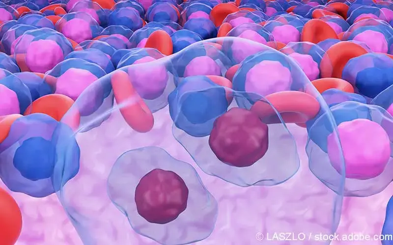 Reed-Sternberg-Zellen Hodgkin-Lymphom