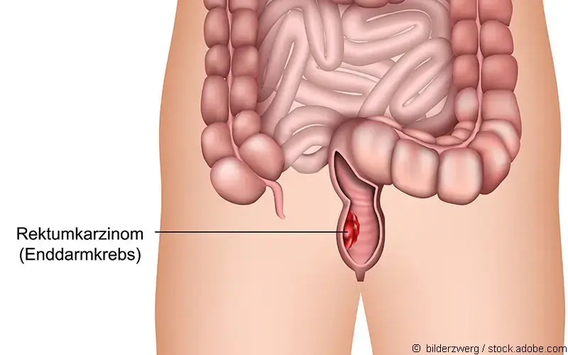 Rektumkarzinom-Illustration