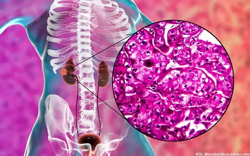 Tumormetastasen im CT