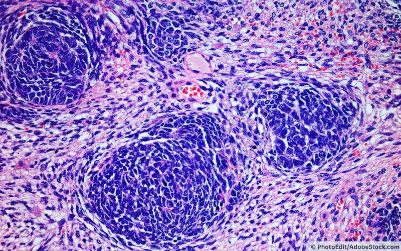 Wilms-Tumor-Nephroblastom
