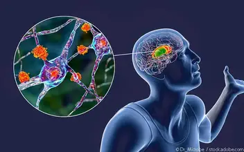 Neuronale Degeneration Chorea Neuronale Degeneration Chorea
