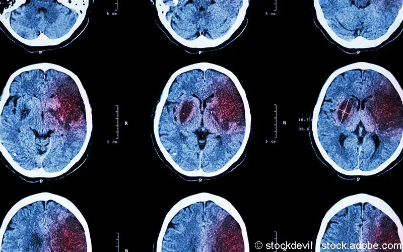 Was ist ein stummer Hirninfarkt?