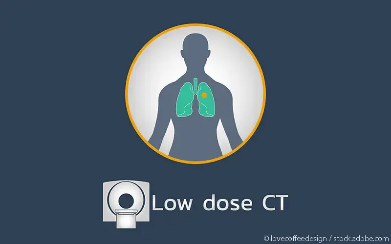 Low Dose Lungen-CT