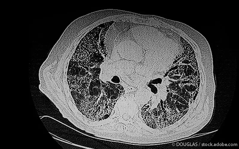 Lungenfibrose CT-Scan