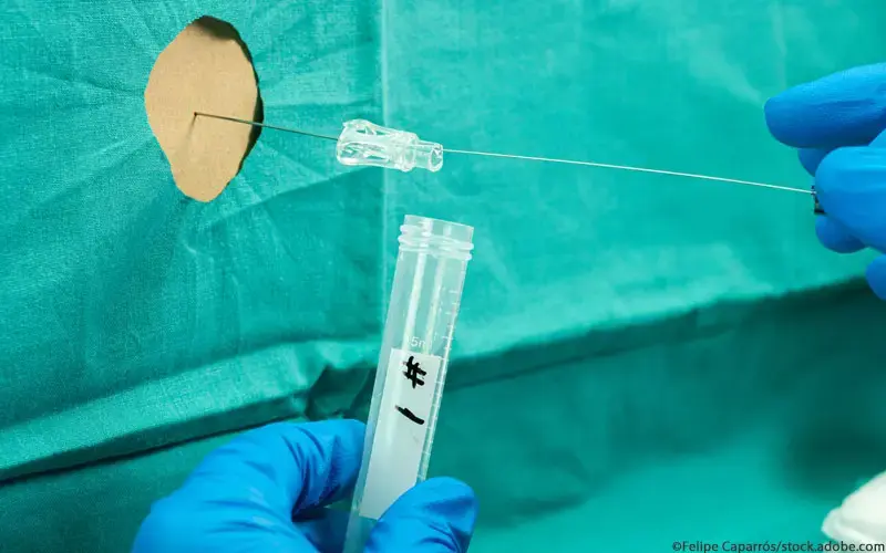 Rückenmark Liquorgewinnung