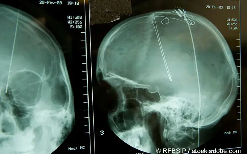 Tiefe Hirn-Stimulation Roentgenbild