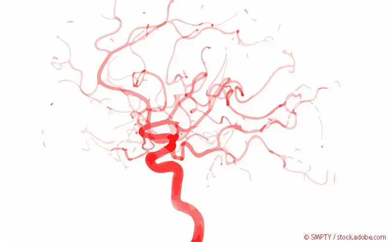 zerebrales Angiogramm