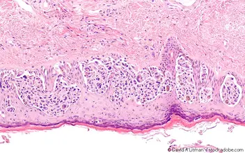 Melanombiopsie Melanombiopsie
