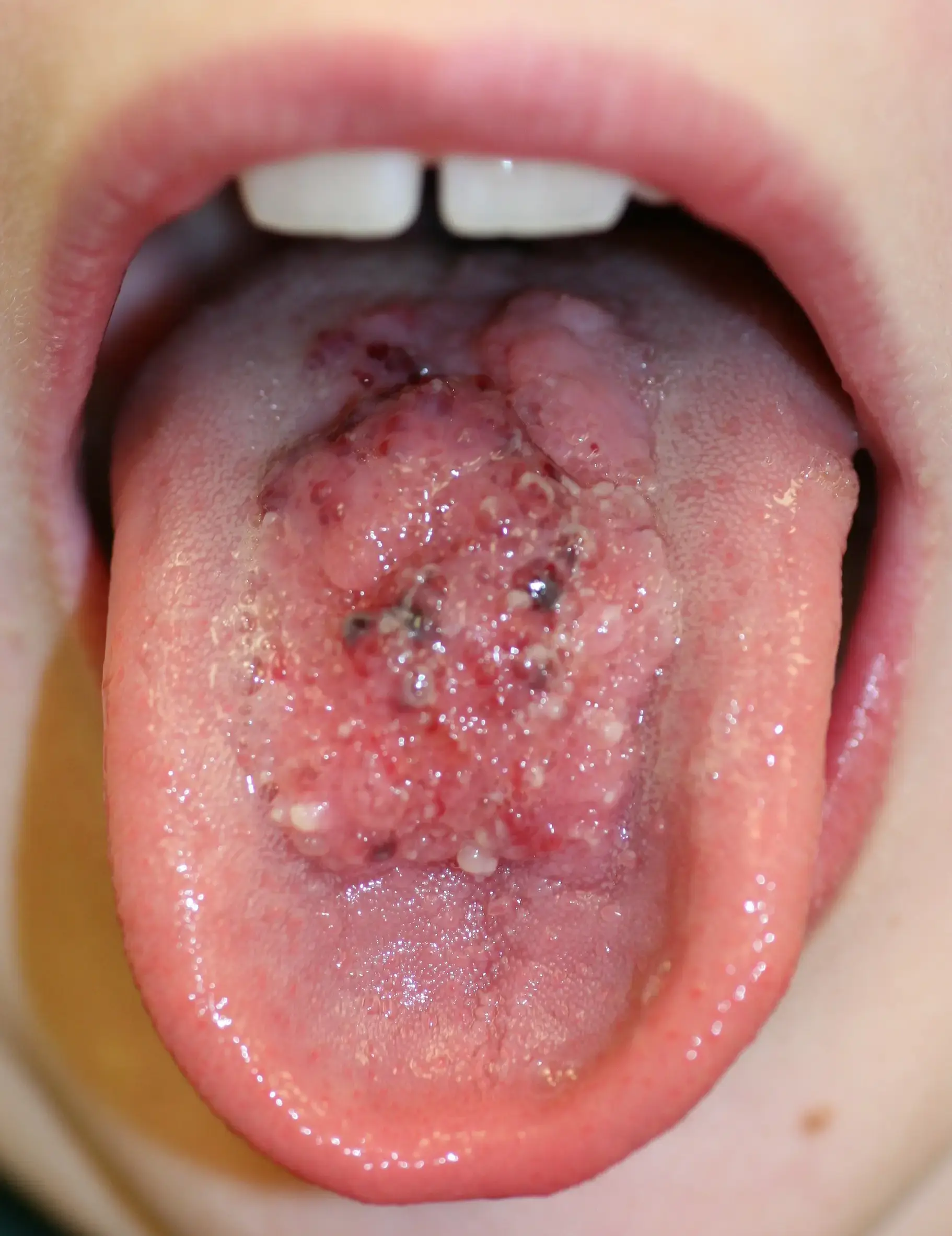 Lymphatishce Malformation an der Zunge