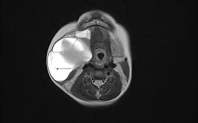 MRT derselben venösen Malformation