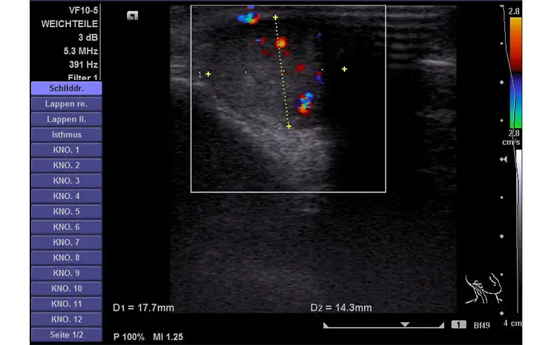 Sonographie der venösen Malformation