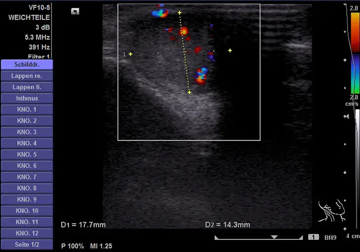 Sonographie der arteriovenösen Malformation