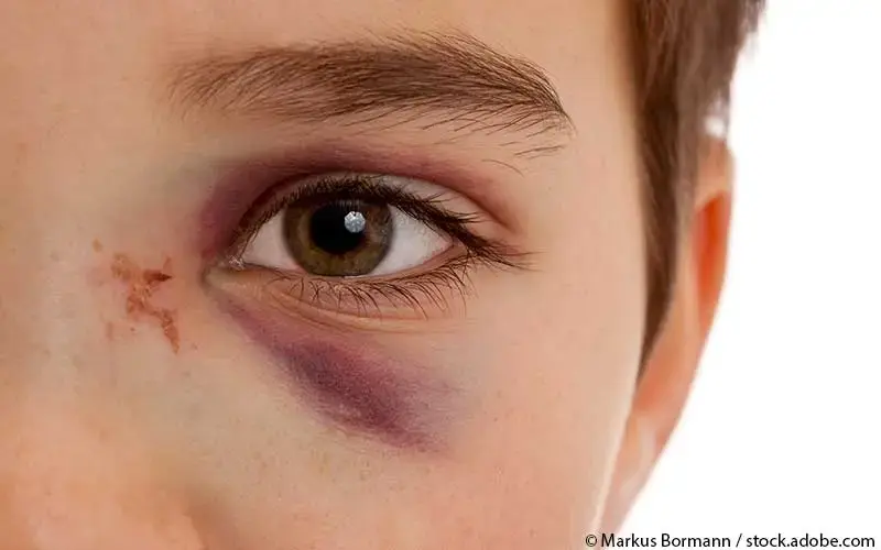 Augenverletzung Kind