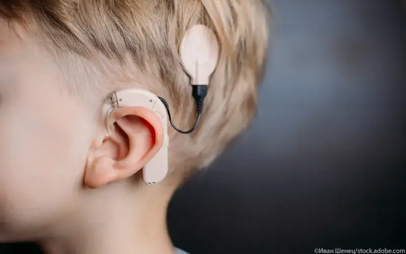 Cochlear-Implant