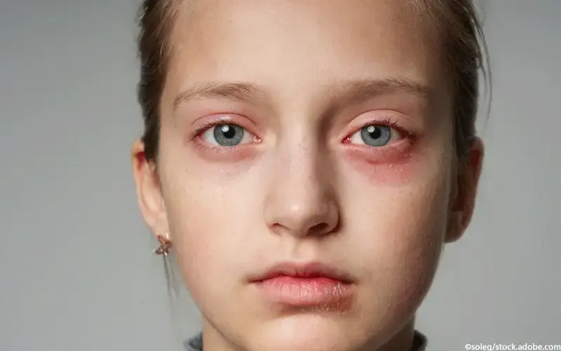 Hauterkrankung Mädchen