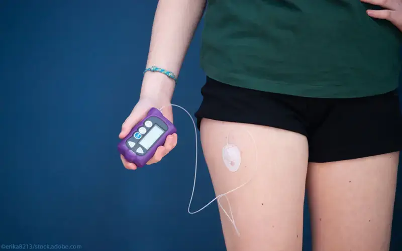 Insulinpumpe Jugendliche