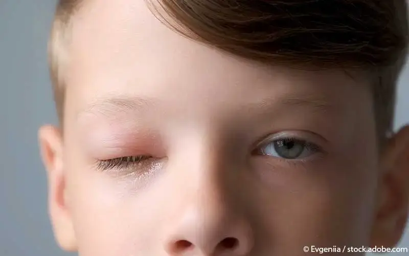 Junge geschwollenes Lid