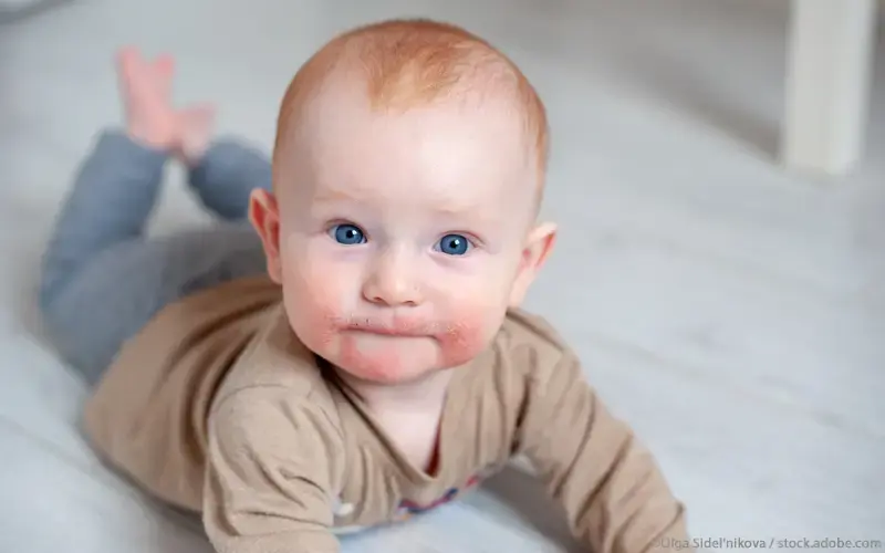 Kind atopische Dermatitis