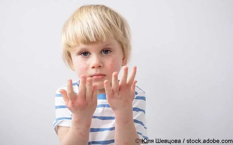 Kind mit Nahrungsmittelallergie