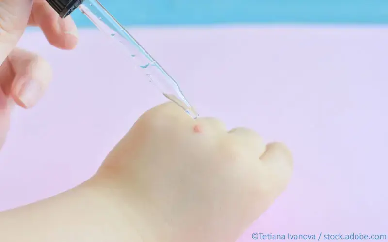 Warzen-Behandlung Kind