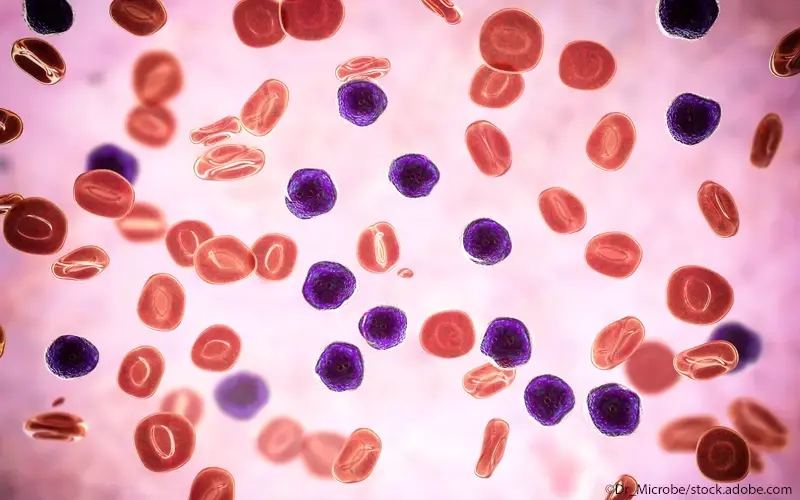 Akute lymphatische Leukämie (ALL)
