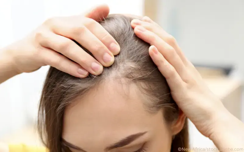 Alopecia areata Frau