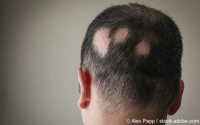 Alopecia areata Mann