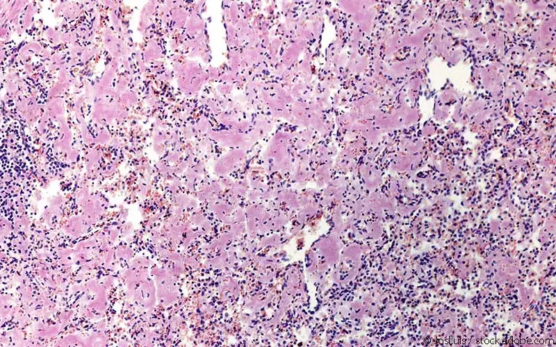 Amyloidose