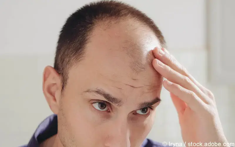Androgenetische Alopezie