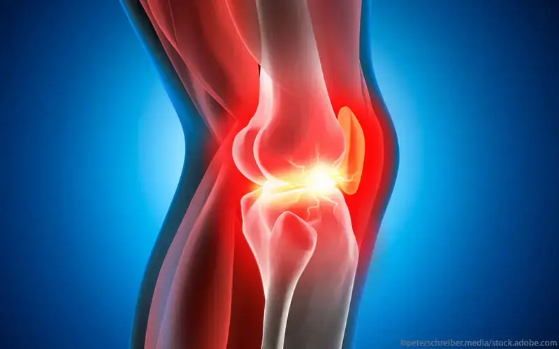 Arthrose, Kniegelenk