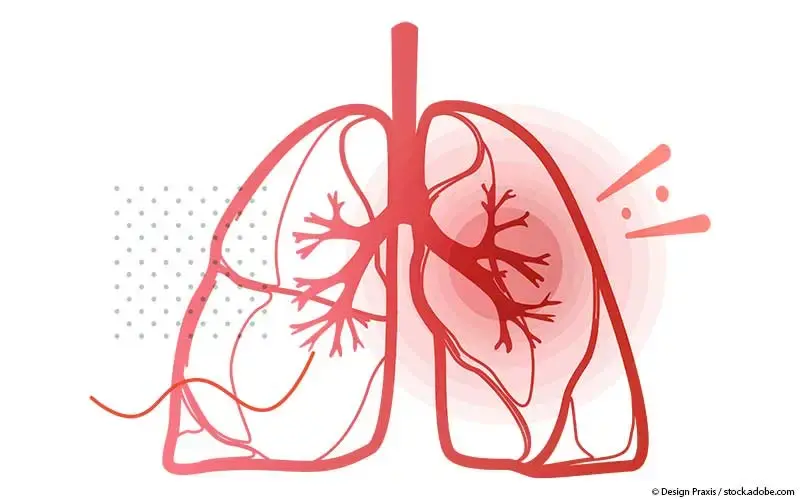Asthma Darstellung schematisch