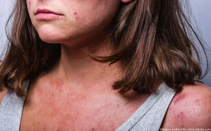 Atopische Dermatitis schwer