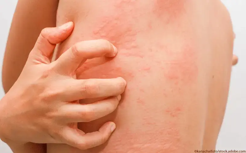Ausschlag juckend