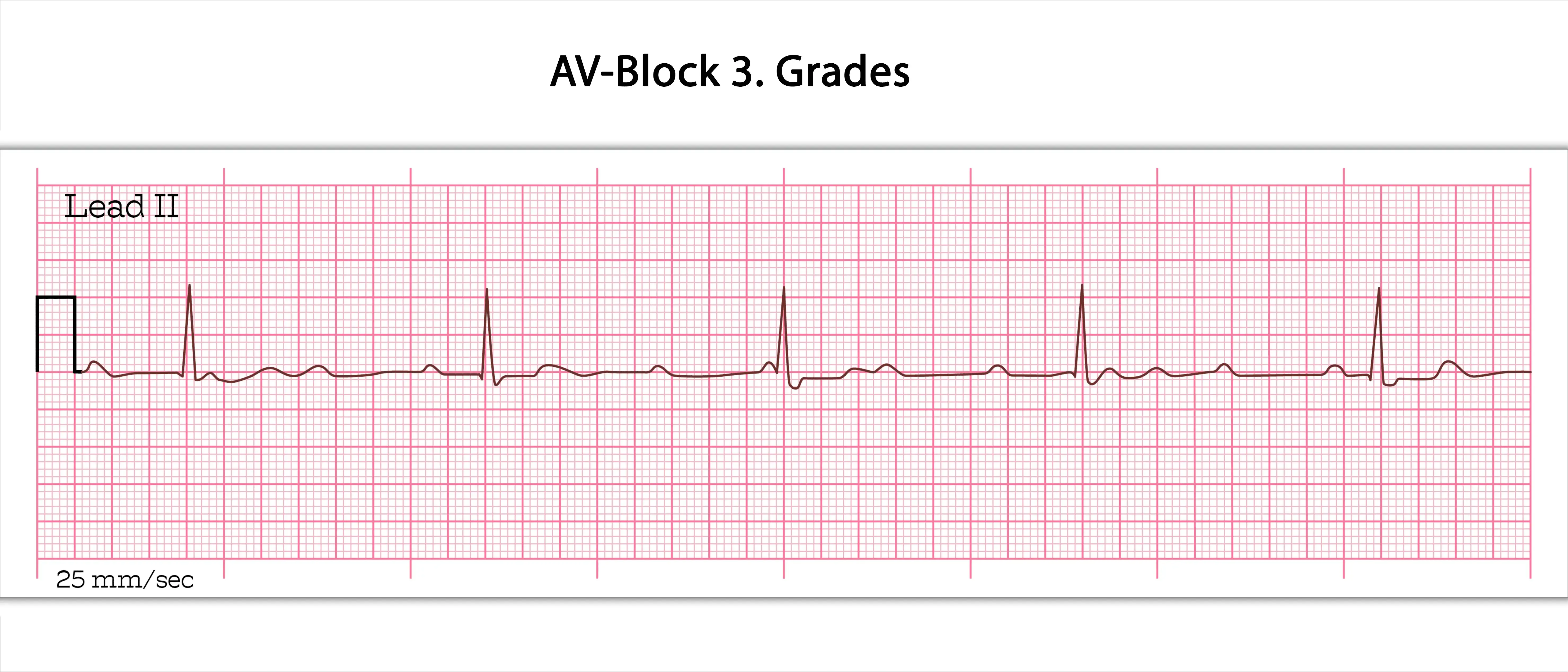 AV-Block-3.-Grades