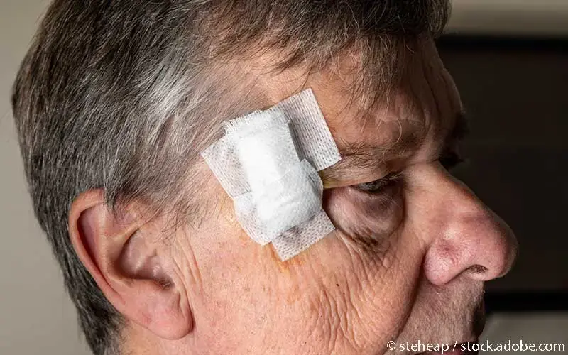 Basalzellkarzinom Kopf