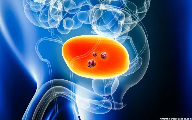 Blasenkrebs Urothelkarzinom